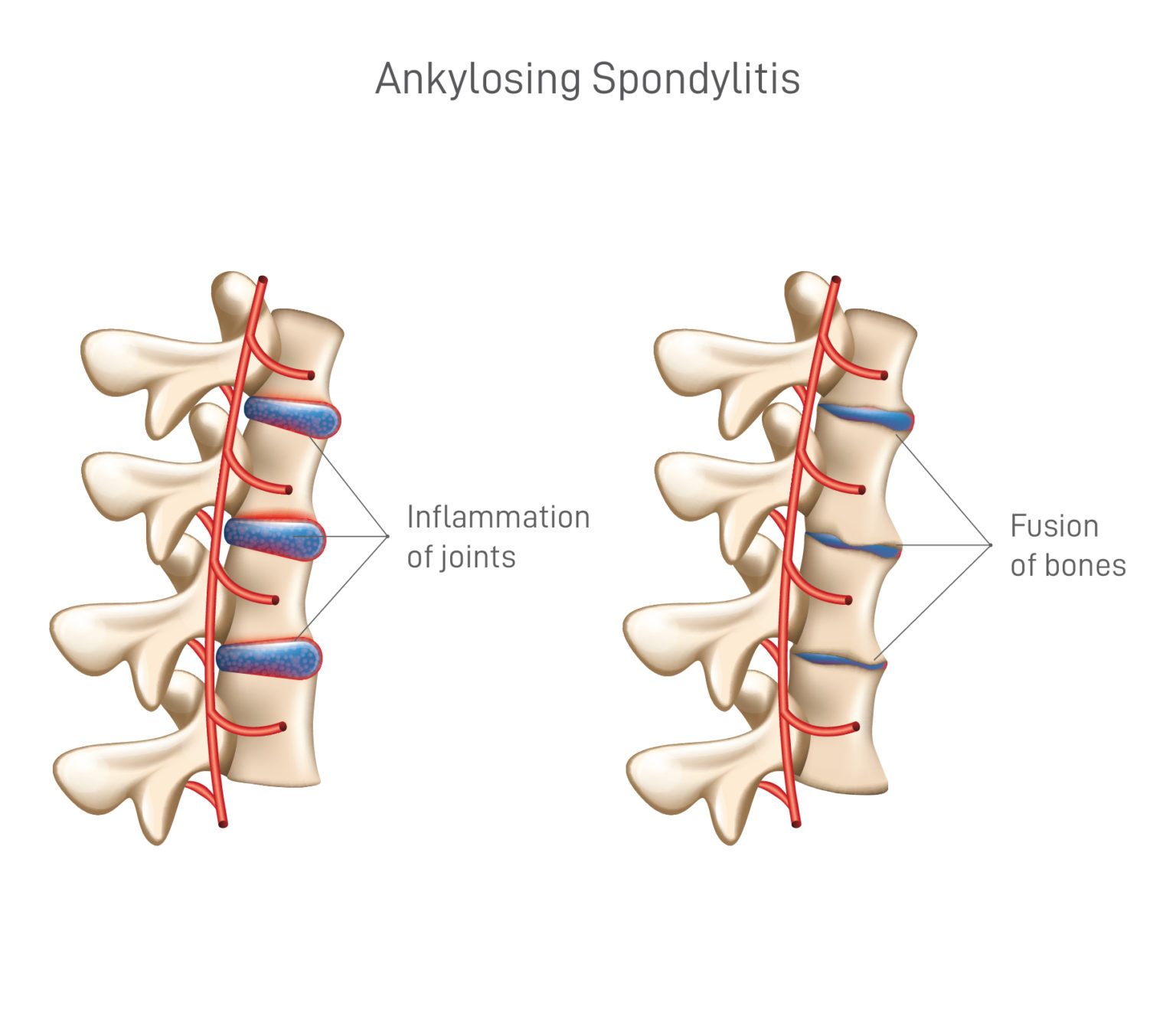 Ankylosing Spondylitis Chart