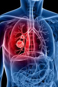 illustrative image of lung cancer