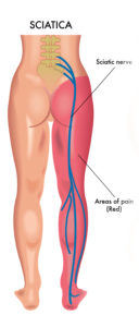 pinched sciatic nerve radiation